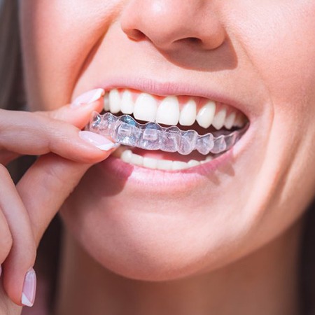 a woman putting on custom clear aligners
