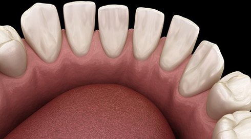 a 3D depiction of crowded teeth