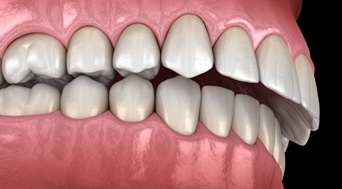 a 3D depiction of gaps between teeth