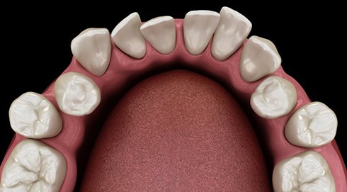 a 3D depiction of an overbite