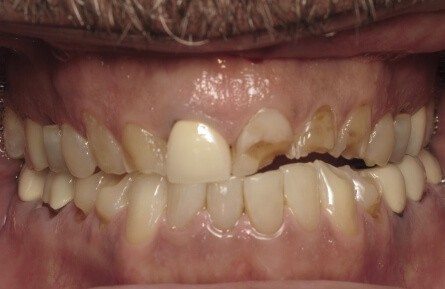 Decayed and damaged top teeth