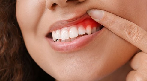 a woman showing signs of gum disease