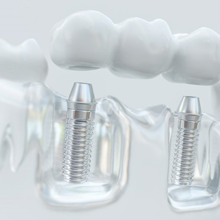 Model of implant bridge