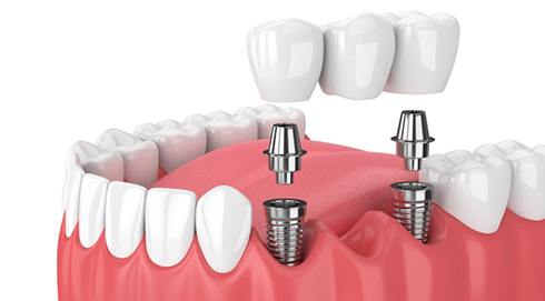 Model of implant bridge?