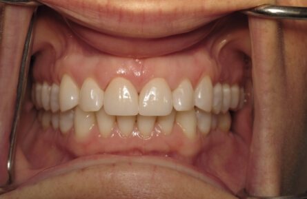 Flawless smile after cosmetic dentistry