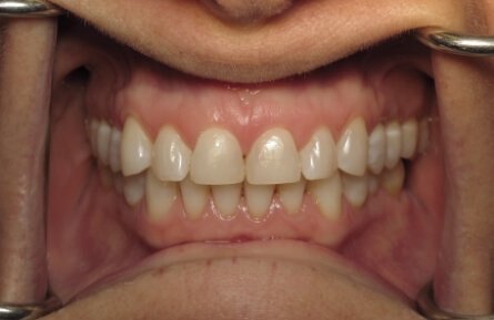 Imperfect smile before cosmetic dentistry