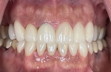 Smile after tooth decay and damage is repaired