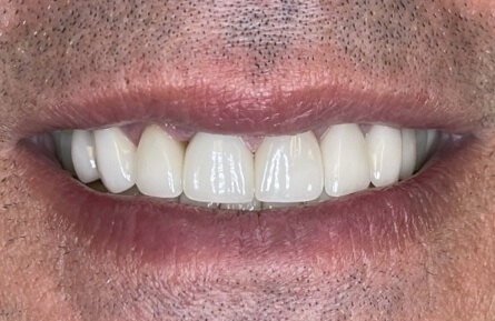 Smile after top teeth are repaired and replaced