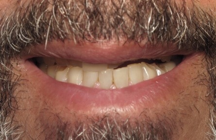 Smile with damaged and missing top teeth