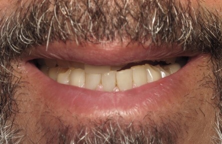 Smile with damaged and missing top teeth