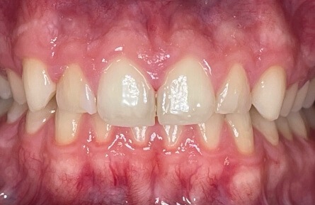 Worn and thin top teeth