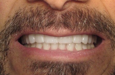 Closeup of healthy smile after treatment