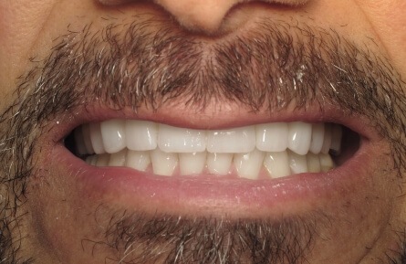 Closeup of healthy smile after treatment