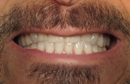 Closeup of smile with dental damage before treatment
