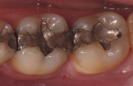 Smile with dark metal fillings