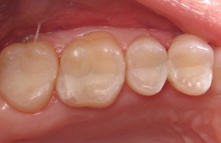 Three teeth with natural looking tooth colored fillings
