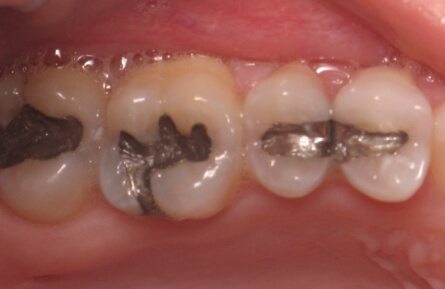 Three teeth with dark fillings