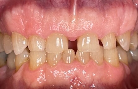 Closeup of smile with gaps between teeth