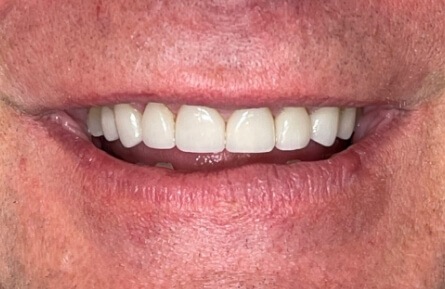Gap closed between top front teeth