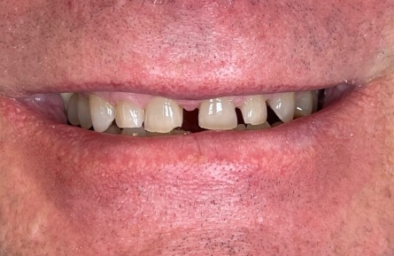 Closeup of smile with large gap between top front teeth