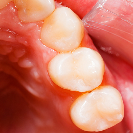 Closeup of teeth with tooth colored fillings