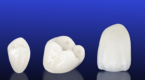 Three all-ceramic dental crowns on blue background