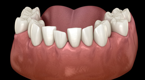 Illustration of crooked teeth