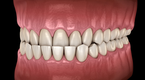 Illustration of an underbite