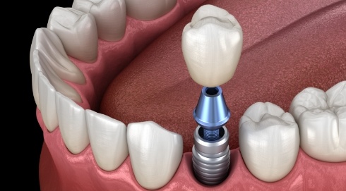 Animated smile during dental implant supported dental crown placement