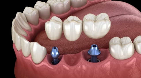 Animated smile during dental implant supported fixed bridge placement