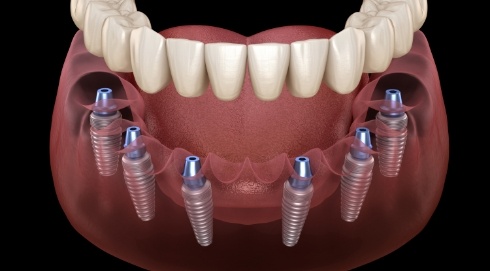 Animated smile during dental implant supported denture placement