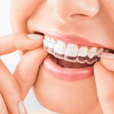a person wearing Invisalign trays in Novi