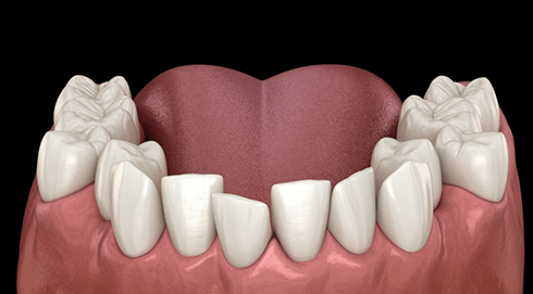 a digital illustration of crowded teeth