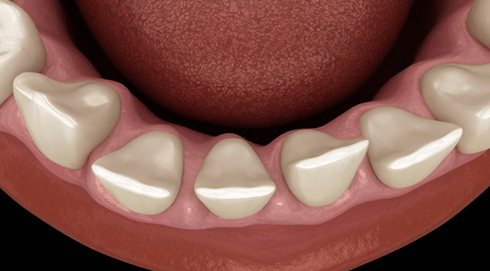 a digital illustration of gapped teeth