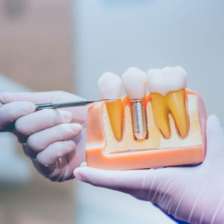 Model comparing dental implants to natural teeth