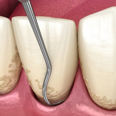 Animated smile during scaling and root planing gum disease treatment