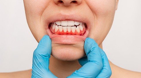 Person with red gum tissue