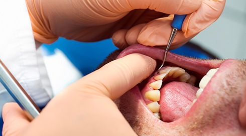 Patient undergoing scaling and root planing