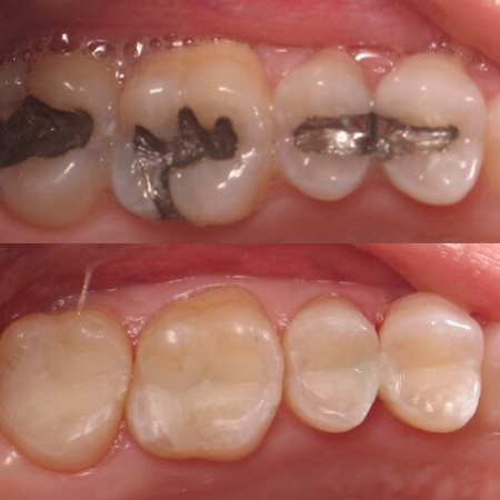 Smile with metal fillings before treatment and tooth colored fillings after