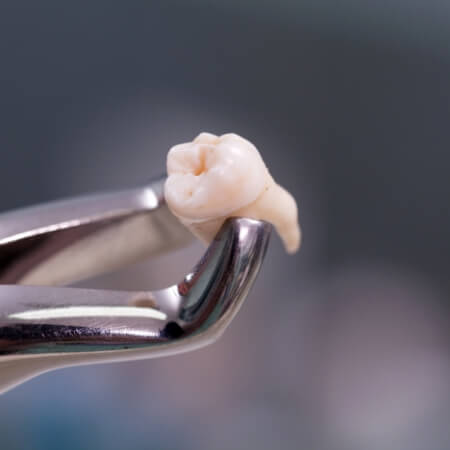 Metal clasp holding tooth after extraction