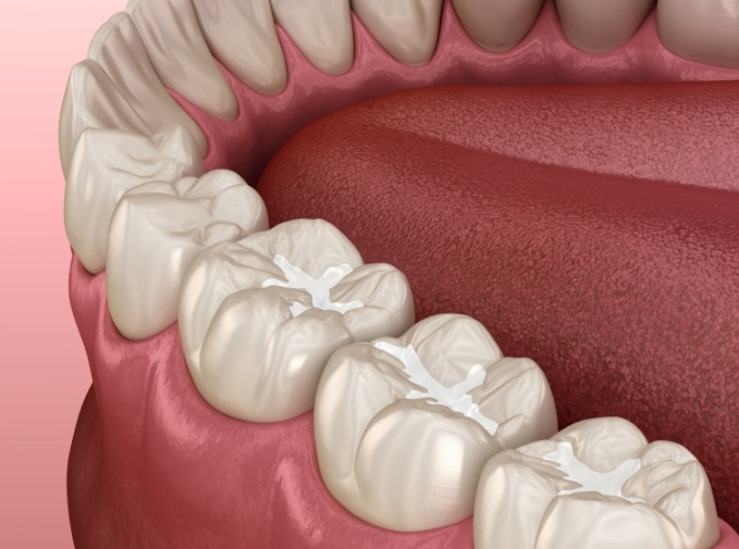 Animated smiles with dental sealants