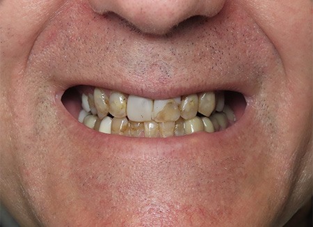 Dentist showing dentistry patient dental implant model